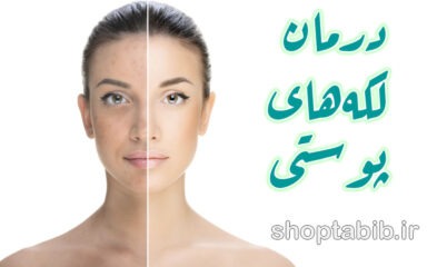لکه‌های سیاه و قهوه‌ای روی پوست؛ چه چیزی پشت این لکه‌ها پنهان است؟
