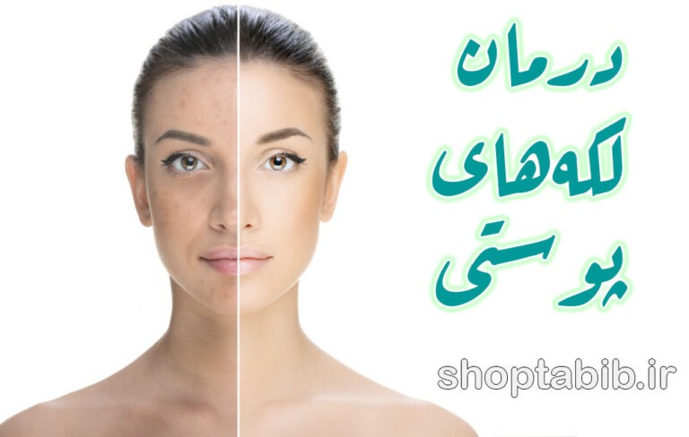 لکه‌های سیاه و قهوه‌ای روی پوست؛ چه چیزی پشت این لکه‌ها پنهان است؟