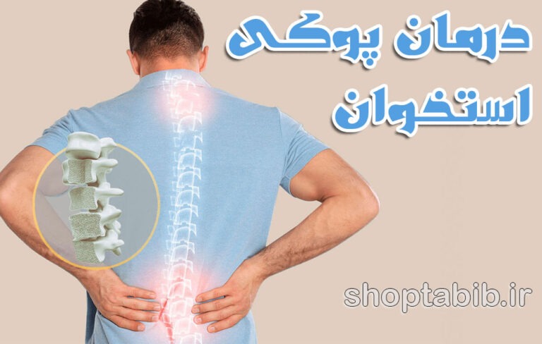 پوکی استخوان؛ علل، علائم و راهکارهای درمان