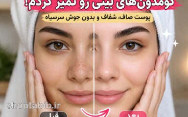 کومدون بینی را چطور از بین ببریم؟ ۷ روش طبیعی و پزشکی که باید بدانید