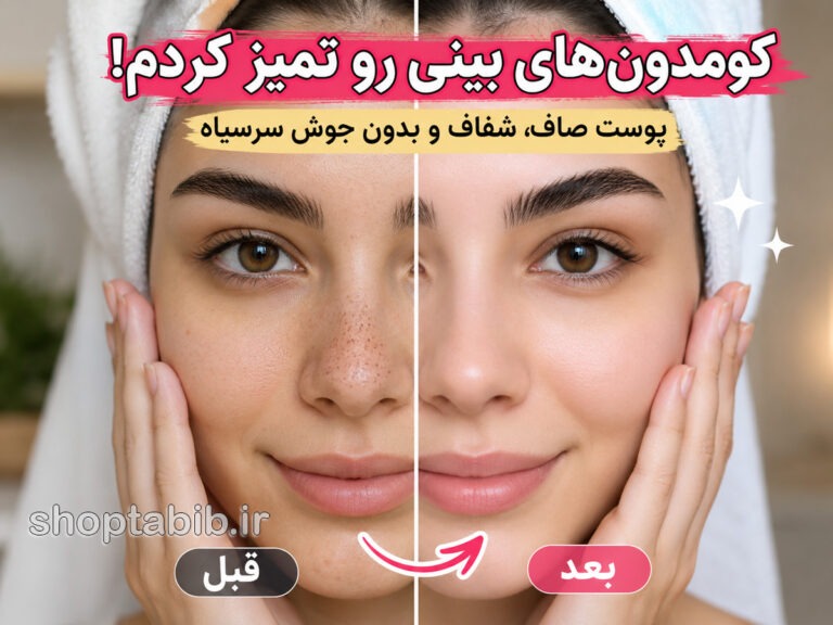 کومدون بینی را چطور از بین ببریم؟ ۷ روش طبیعی و پزشکی که باید بدانید